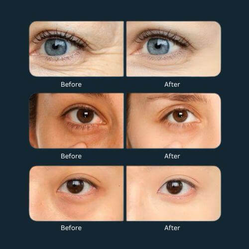 Before and after results of VitaVision eye treatment